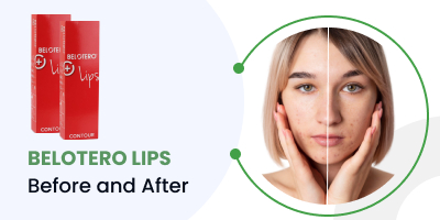 belotero lips before and after