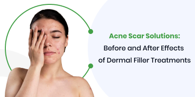 Acne Scar Solutions: Before and After Effects of Dermal Filler Treatments