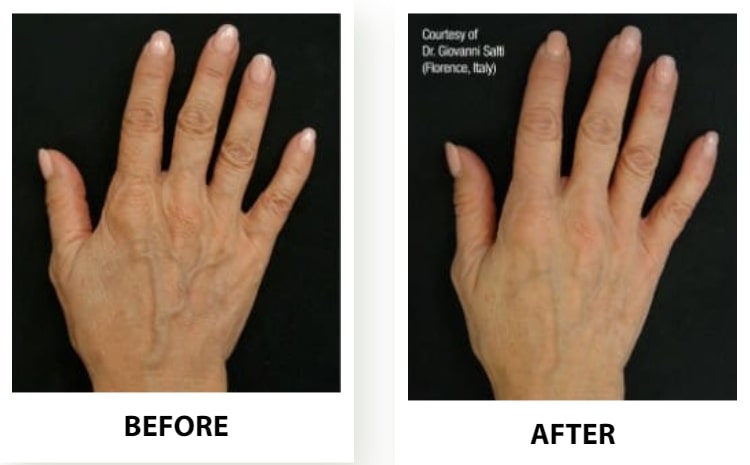 Profhilo for hands before and after