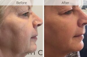 Profhilo jowls before and after