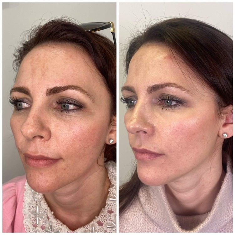 Profhilo Under Eyes Before and After