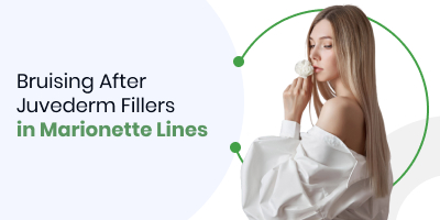 Bruising After Juvederm Fillers in Marionette Lines