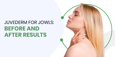 Juvederm for Jowls: Before and After Results