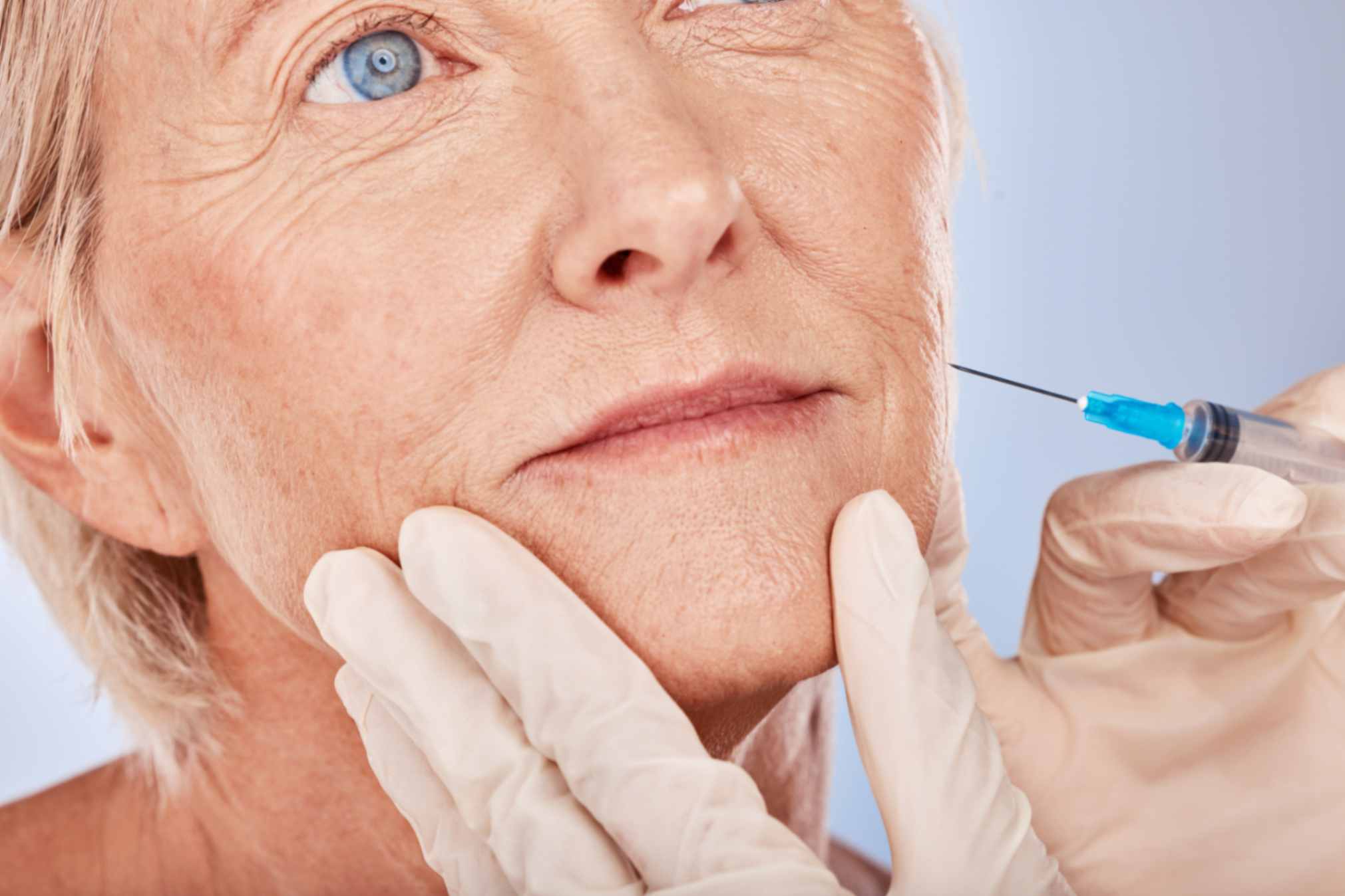 Juvederm for Jowls: Before and After 