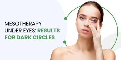 Mesotherapy Under Eyes: Results for Dark Circles