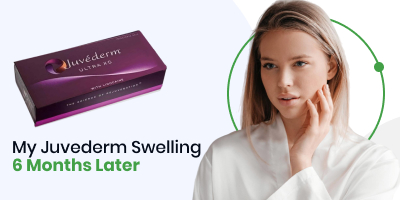 My Juvederm Swelling 6 Months Later