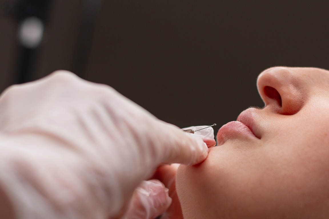 Natural Looking Lip Fillers: Techniques And Shapes