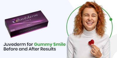 Juvederm for Gummy Smile Before and After Results