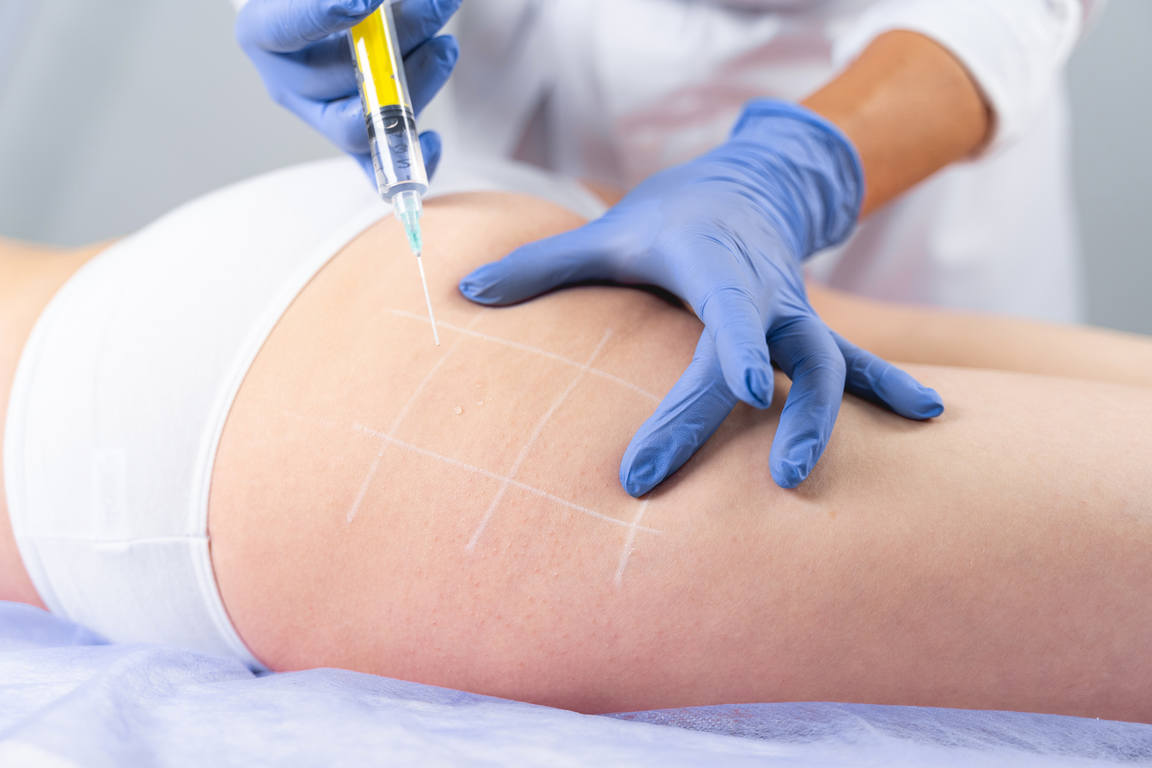 Juvederm Buttocks Injections: Volume and Shape