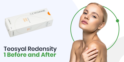 Teosyal Redensity 1 Before and After